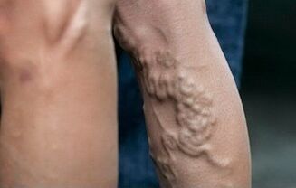 Venas varicosas en las piernas