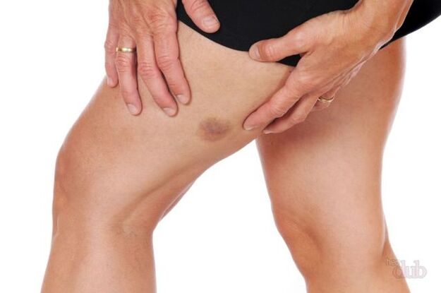 cuando una vena estalla